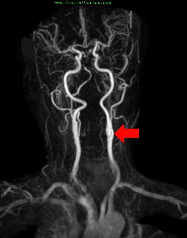 MRA Gad Bolus Left Carotid Bifur