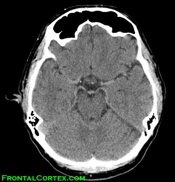 CT Circle of willis