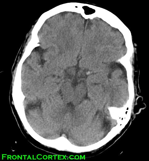 CT dense MCA