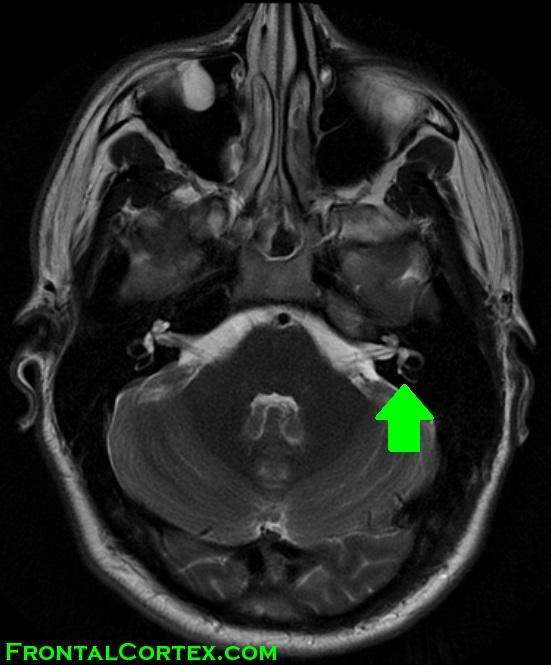 MRI T2 semicircular canals