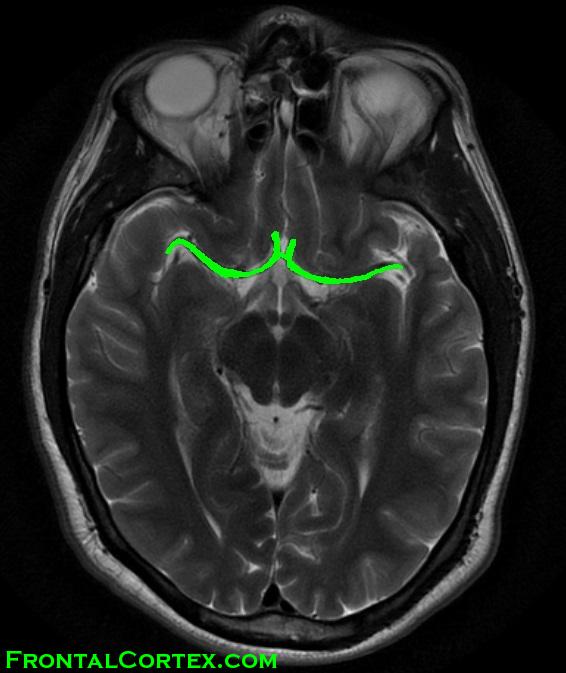 T2 MRI MCA ACA highlighted