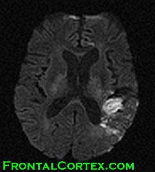 MRI Fluent Aphasia