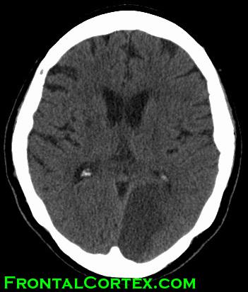 CT left PCA stroke