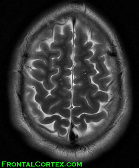 MRI T2 Virchow Robin spaces