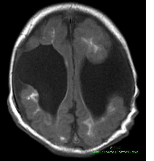 Schizencephaly MRI