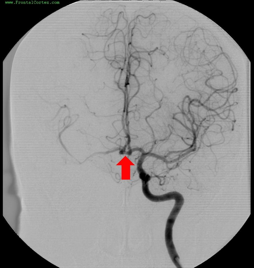 Angiogram 2 ACA ACOM