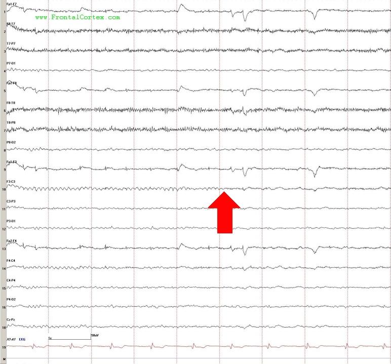 EEG Normal with Mu