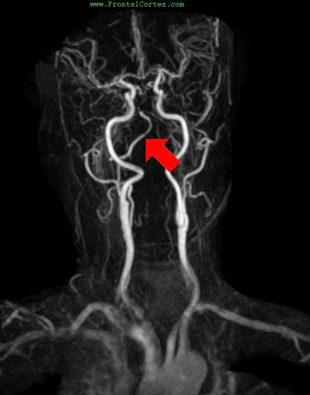 MRA Gad Bolus Right Vertebral Ar