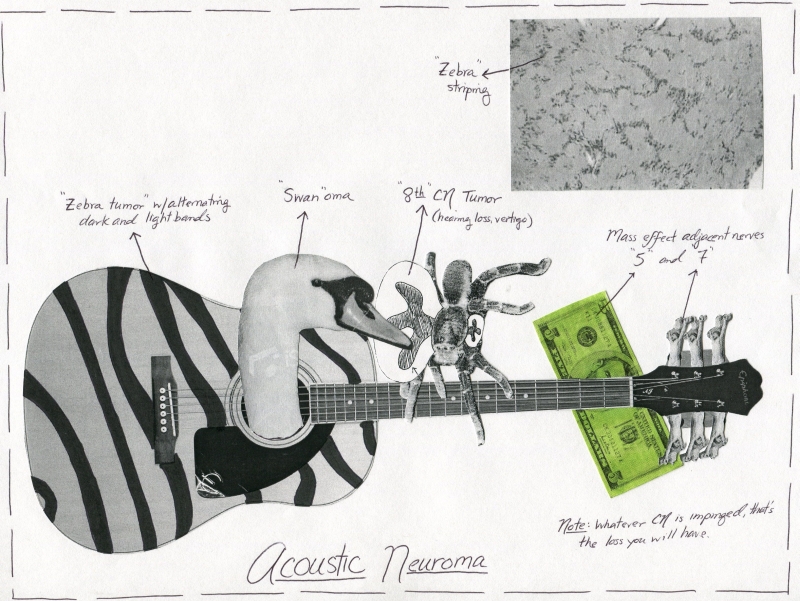 Acoustic Neuroma