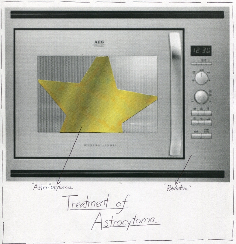 Astrocytoma Treatment