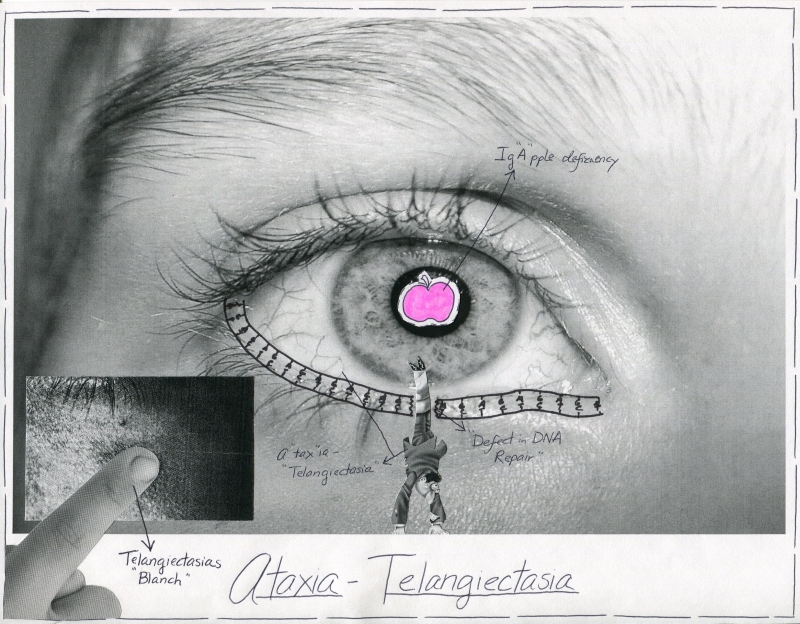 Ataxia-Telangiectasia