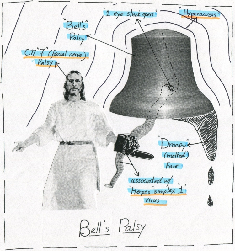 Bell's Palsy