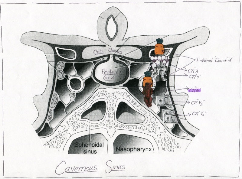 Cavernous Sinus