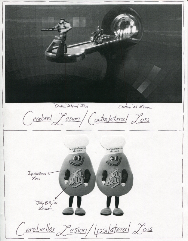 Cerebral vs Cerebellar Laterality