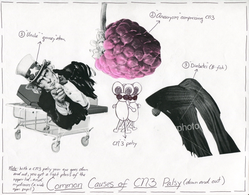 Common Causes Of Cranial Nerve 3 Palsy