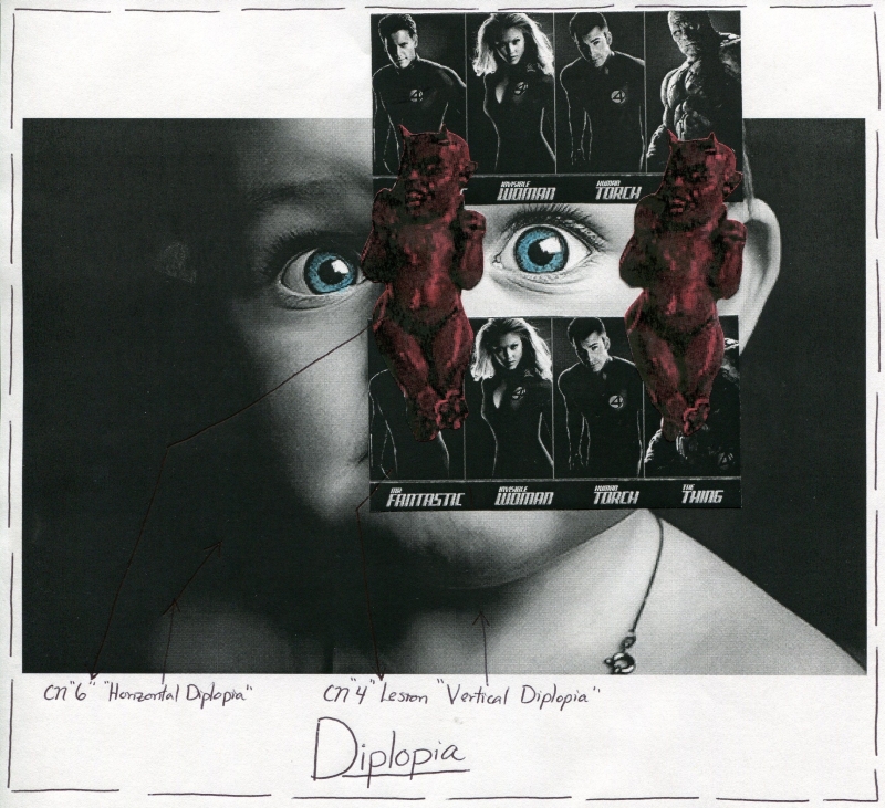 Diplopia