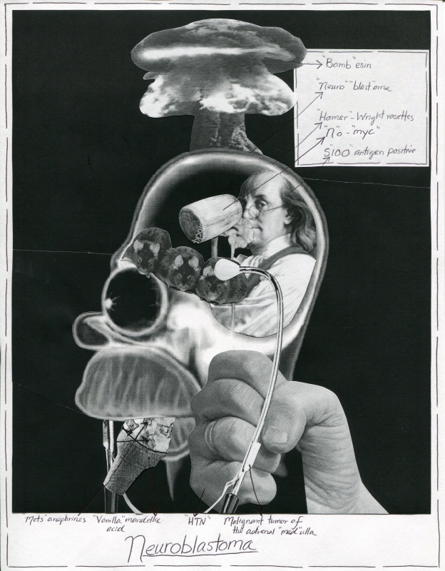 Neuroblastoma