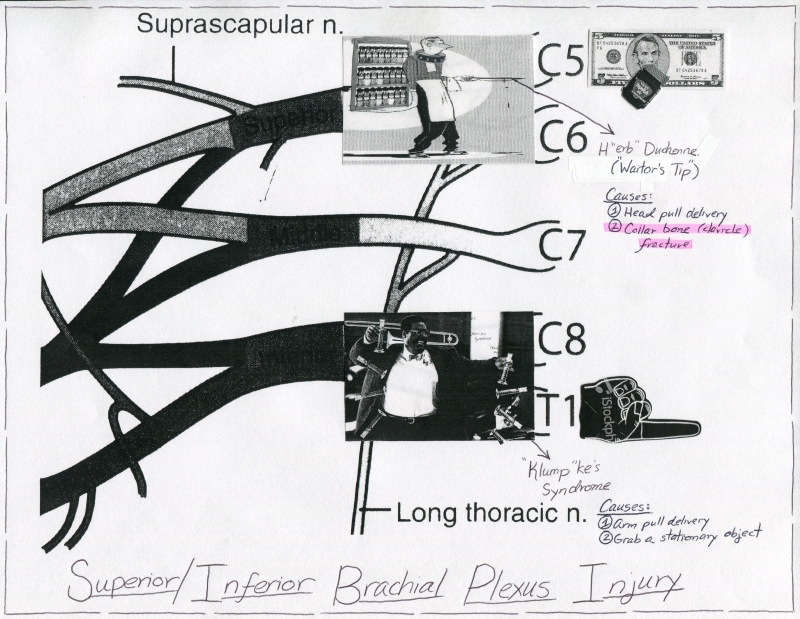 Superior vs. Inferior Brachial Plexus Injury