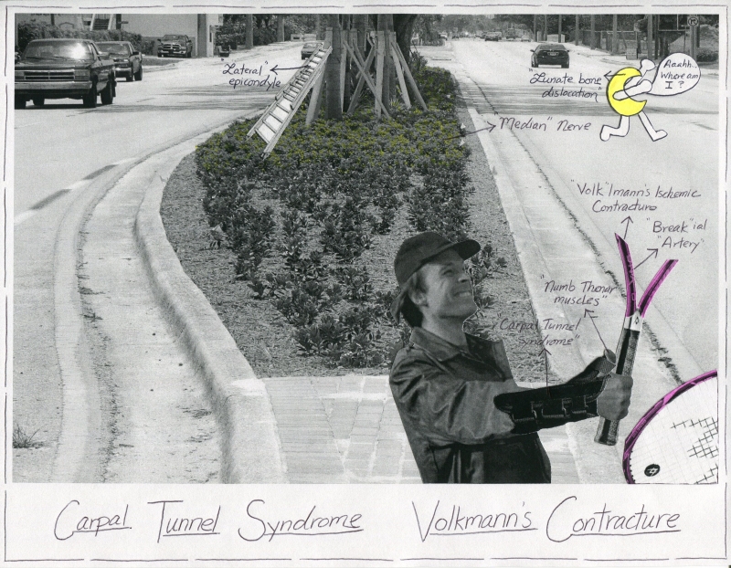 Volkman's Contracture