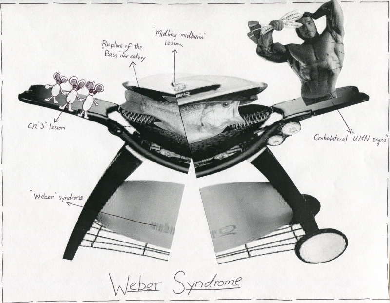 Weber Syndrome