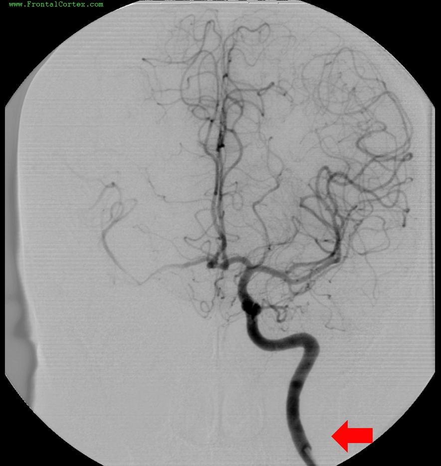 Angiogram 2 ICA Cervical