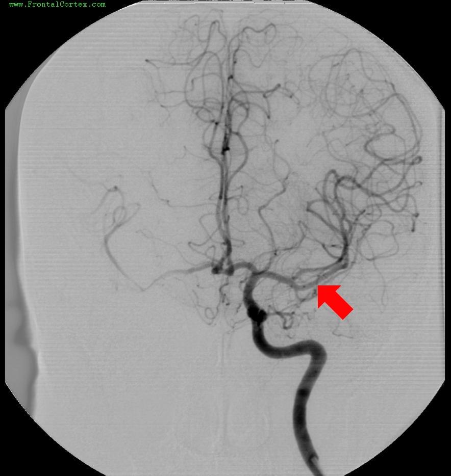 Angiogram 2 MCA M1 again