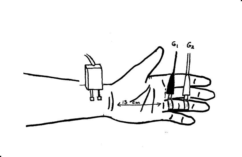 Median Sensory Nerve - Ring Finger (antidromic)