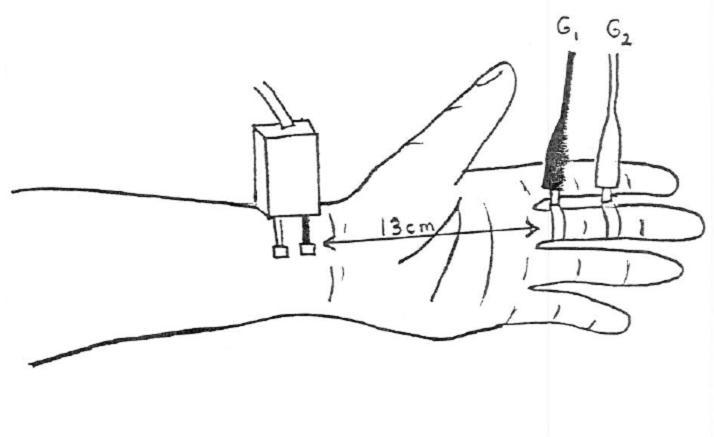 Median Sensory Nerve - middle (antidromic)