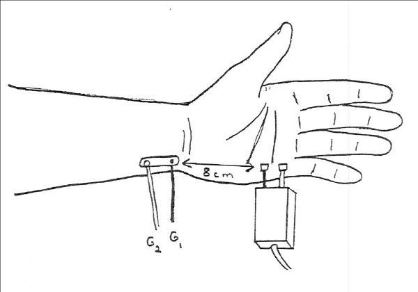 Ulnar Palmar Mixed Nerve (orthodromic)