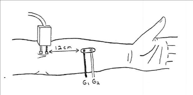 Lateral Antebrachial Cutaneous Sensory Nerve (antidromic)