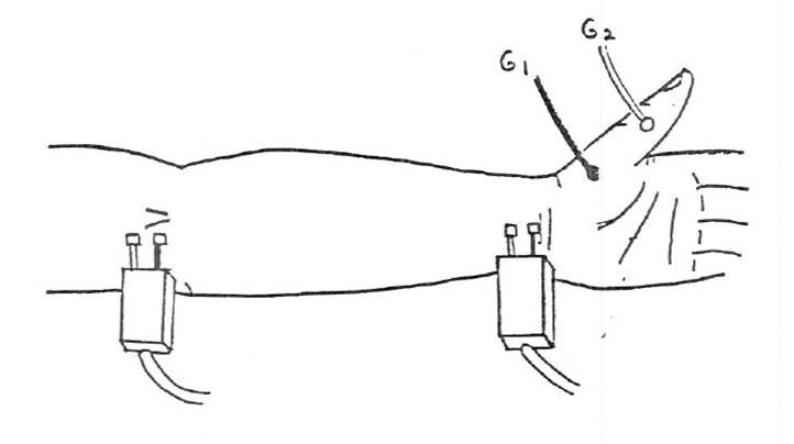 Median Motor Study - Recording the Abductor Pollicis Brevis