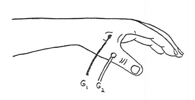 Ulnar Motor Nerve - Recording the First Dorsal Interosseous (FDI)