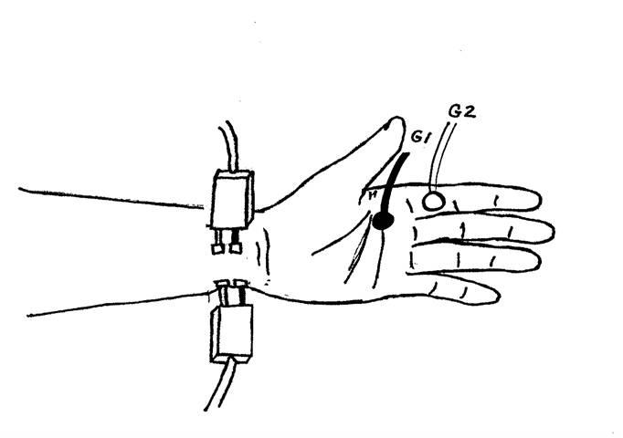 Median and Ulnar motor nerves- Recording the 2nd Lumbrical and interossei