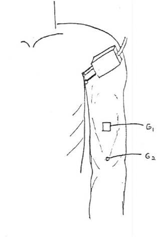 Musculocutaneous Motor Nerve - recording the Biceps