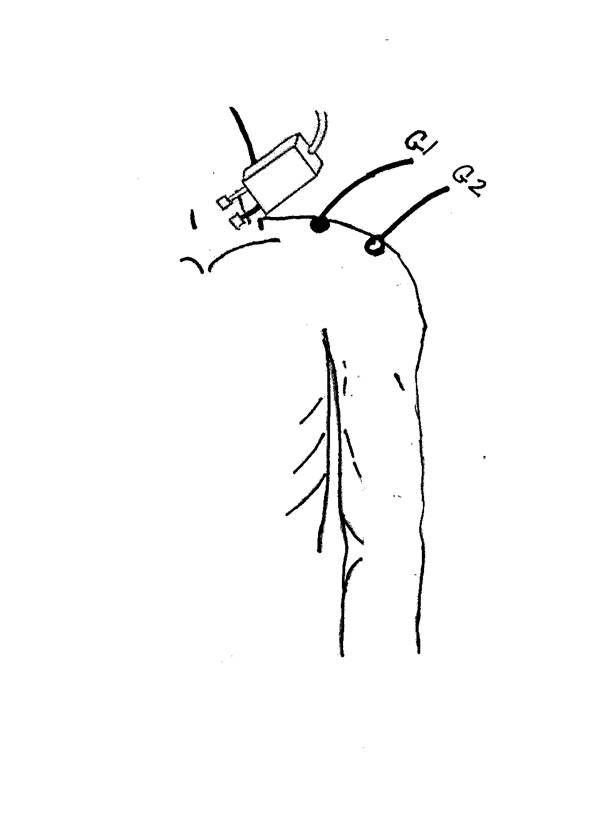 Spinal Accessory Motor Nerve - recording the Trapezius