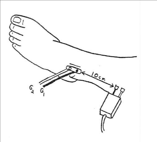 Superficial Peroneal Sensory Nerve - recording anterior to the Lateral Malleolus (antidromic)