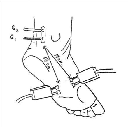 Medial and Lateral Plantar Mixed Nerves (orthodromic)