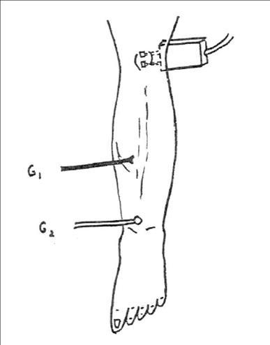 H-Reflex - recording the Soleus