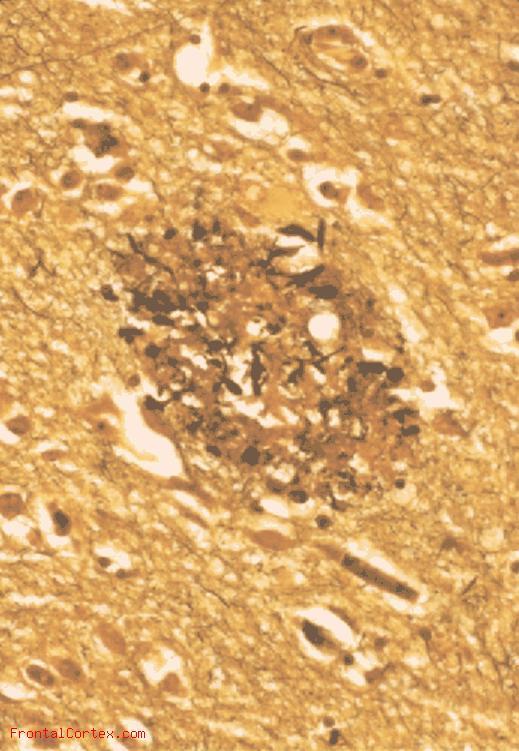 Amyloid Plaque NIA