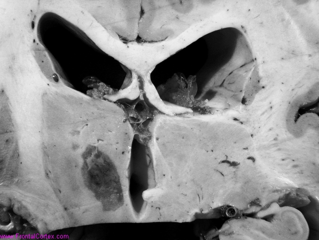 Unilateral thalamic infarct