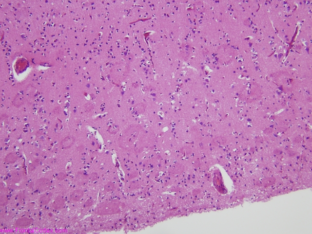 Familial (PS1) Alzheimer's disease, cerebral cortex, H&E stain