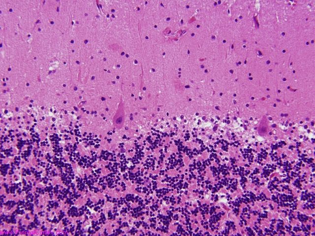 Cerebellar plaques in familial Alzheimer's disease.