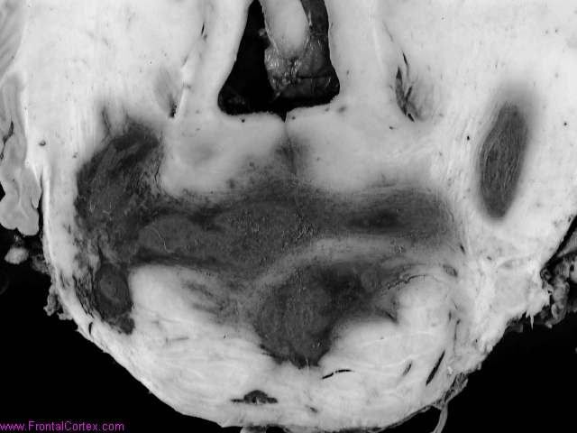 Primary pontine hemorrhage in a