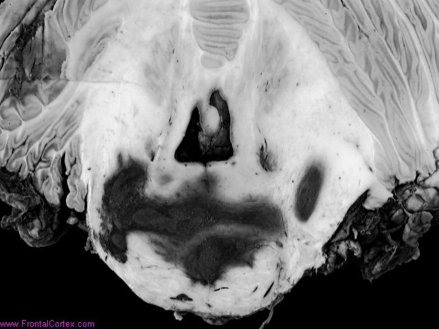 Primary pontine hemorrhage in a