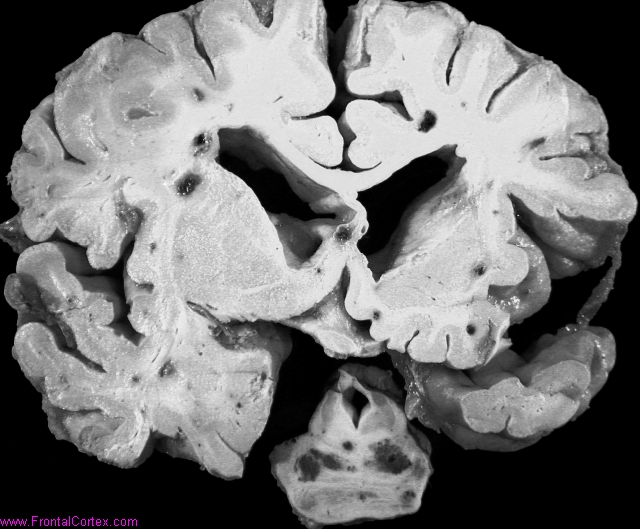 Multiple cavernous malformations