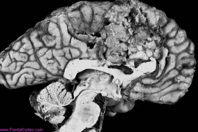 Organizing infarct, anterior cer