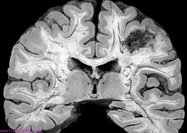 Arteriovenous malformation