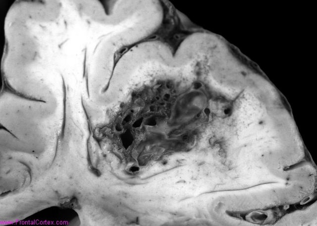 Arteriovenous malformation