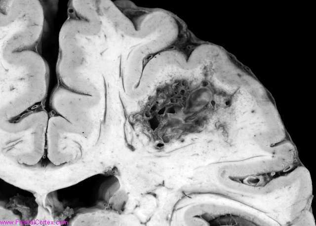 Arteriovenous malformation