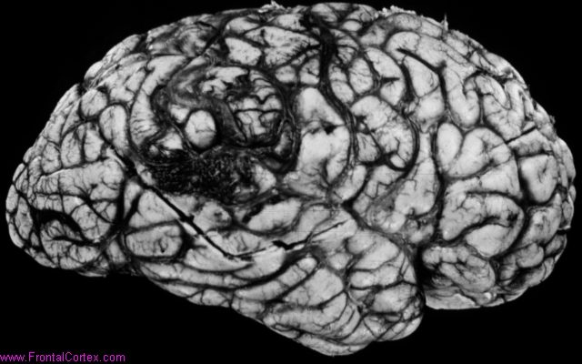 Arteriovenous malformation, late